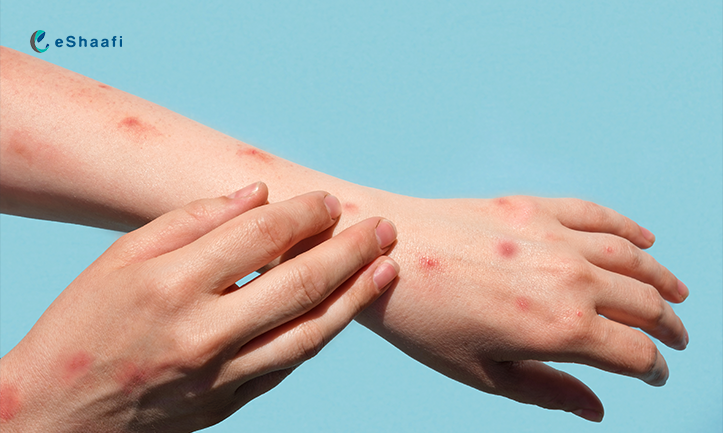 Monkeypox Alert: Recognizing Symptoms and Protecting Yourself